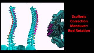 Spinologics Spinal Surgery Simulation (Ansys Hall of Fame Winner)