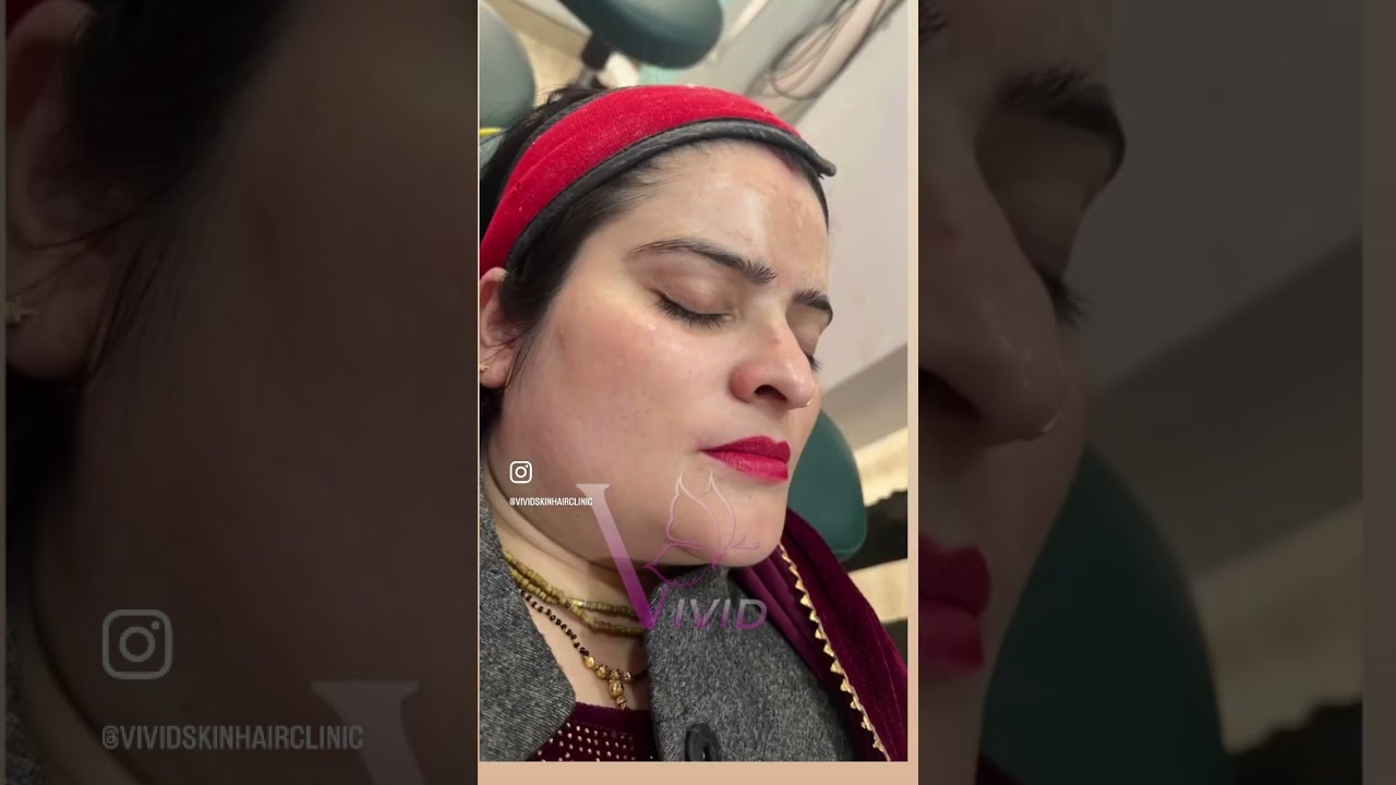 Melasma Treatment & Skin Brightening Results in Ghaziabad