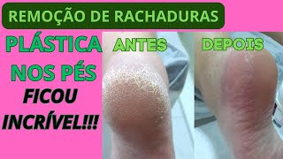 Remoção de Rachaduras com Plástica nos Pés- Spa dos Pés