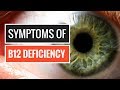 5 Signs and Symptoms of Vitamin B12 Deficiency