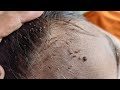 Remove all big lice from his hair - How to remove all hundred lice from his head