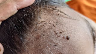 Remove all big lice from his hair - How to remove all hundred lice from his head