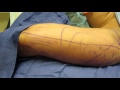 Vaser liposuction of Arms