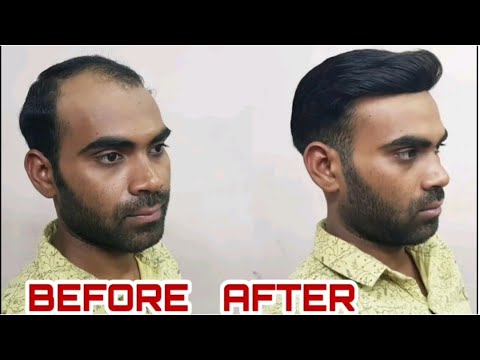 Non surgical hair replacement centre in delhi . hair replacement cost ...