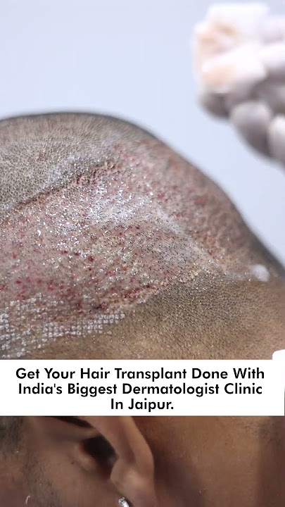 first head wash after hair transplant | How To Wash Your Hair After Hair Transplant | Skinaa Clinic