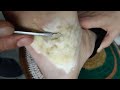 Calluses warts jigger ace foot asmr