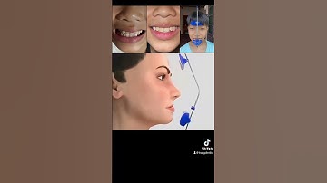 Khí cụ chỉnh khớp cắn ngược trong chỉnh nha