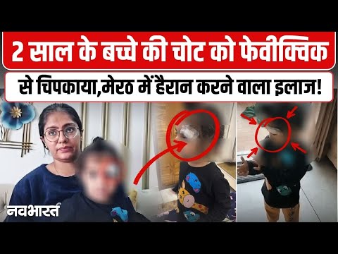 UP News : Meerut के अस्पताल में बड़ी लापरवाही,  बच्चे के घाव पर टांके की जगह लगा दी Fevikwik