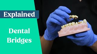 Dental bridges explained (False teeth alternative)