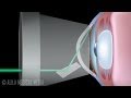 Laser trabeculoplasty for glaucoma alt vs slt animation