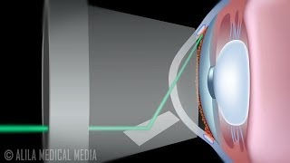 Laser Trabeculoplasty for Glaucoma: ALT vs SLT, Animation.