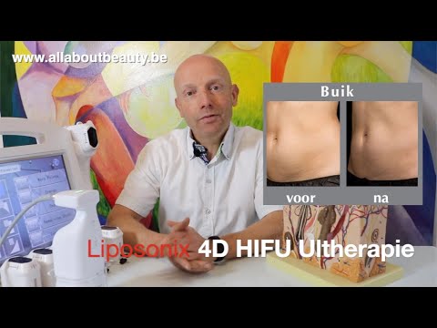 HIFU Liposonix, plaatselijk afslanken zonder liposuctie