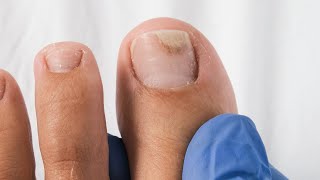 How to regrow a separated toenail. Watch this ASAP