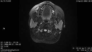 CASE 1113 CT MRI CRANIOPHARYNGIOMA