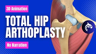 Total Hip Replacement (Arthroplasty) - 3D Animation (No Narration)