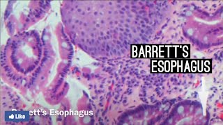 Barrett’s Esophagus
