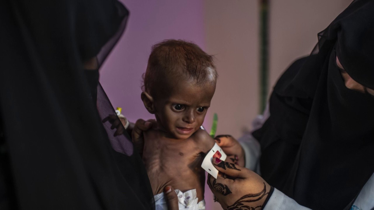 منظمة الصحة العالمية: الأزمة الإنسانية في اليمن الأسوأ في العالم