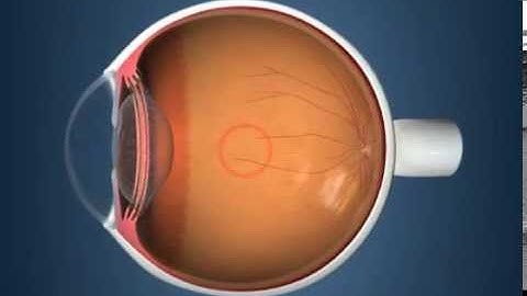 iStent Trabecular Micro-Bypass Video
