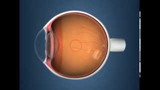 iStent Trabecular Micro-Bypass Video