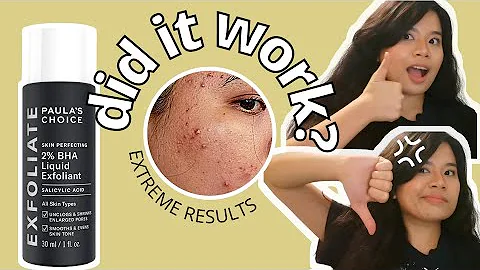 2 MONTHS REVIEW + RESULTS | Paula's Choice 2% BHA Liquid Exfoliant on Sensitive ACNE prone skin| BHA