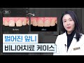 벌어진 앞니, 벌어진 치아를 비니어로 예쁘게 만들기
