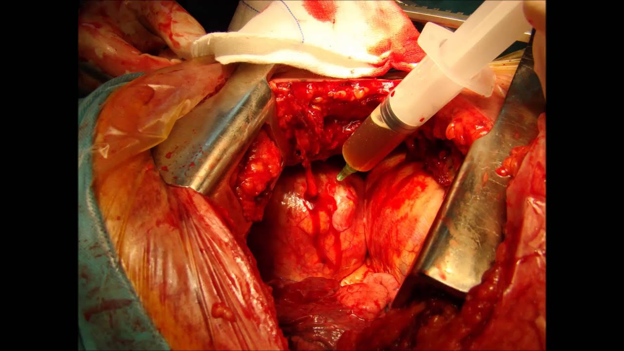 Mediastinal mass: Pericardial cyst - YouTube
