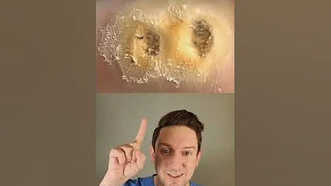 A DERMATOLOGIST explains wart removal & treatment on the FOOT