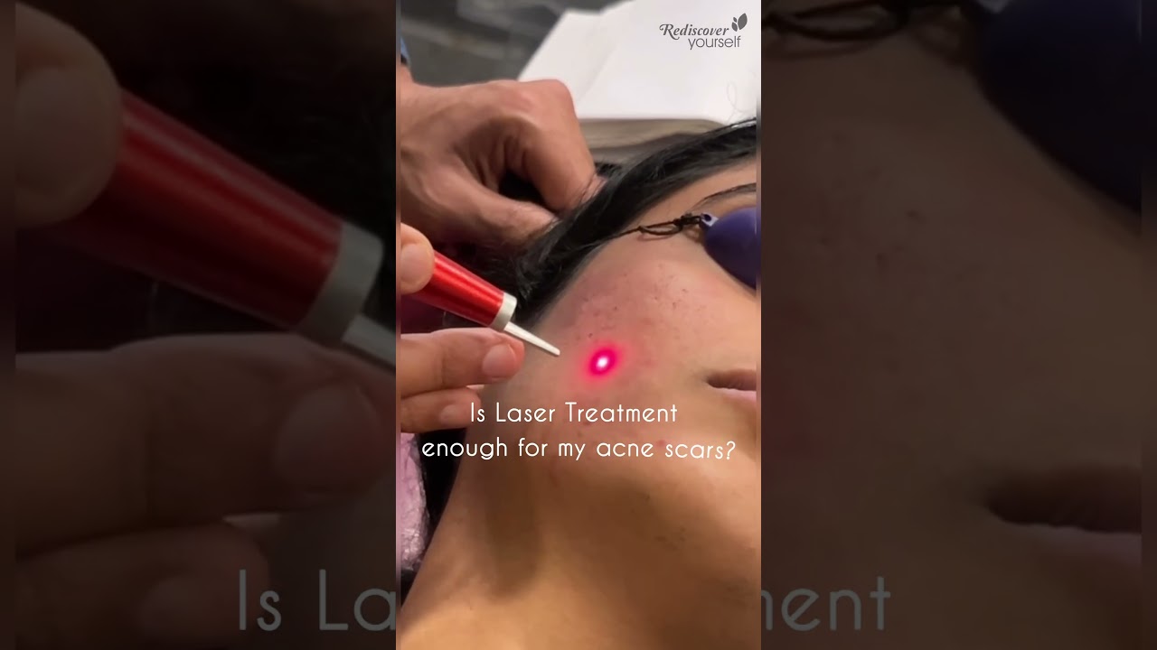 Laser Treatment Not Enough For Acne Scars? #AcneScarCare #PostTreatmentCare