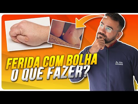 Vídeo: As bolhas de sangue devem ser estouradas?