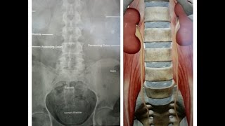 X Ray KUB BASICS (Kidney Ureter Bladder)