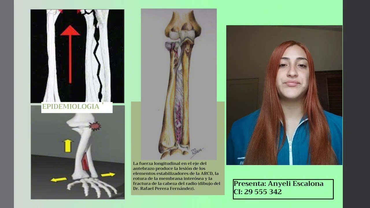 Fractura de Essex Lopresti