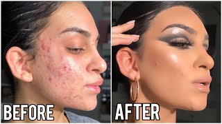 HOW TO ACHIEVE FLAWLESS SKIN WITH ACNE BREAKOUTS (No Filters) | AYESHA AMIR