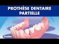 Prothse dentaire partielle 