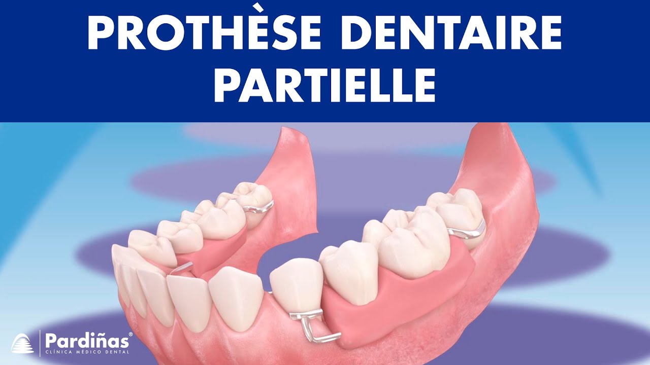 Prothèse dentaire partielle : ce qu'il faut savoir
