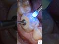 ““Black Cavity Removed Instantly!”#dental #dentalcare #toothpainrelief#dentaltips #oralhygiene#teeth