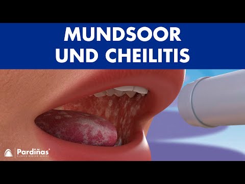 Video: Durch Chemotherapie verursachte Wunden im Mund heilen – wikiHow