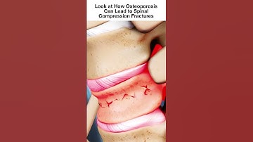 Look at How Osteoporosis Can Lead to Spinal Compression Fractures