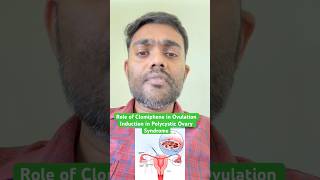 Role of Clomiphene in Ovulation Induction in Polycystic Ovary Syndrome