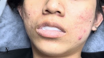 BÀI 6 : HƯỚNG DẪN Ủ TÊ MÔI ĐÚNG CÁCH , Ủ TÊ PHUN MÔI | HỌC PHUN XĂM