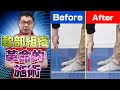 フルヤが腱骨リリースを実際にやってみました