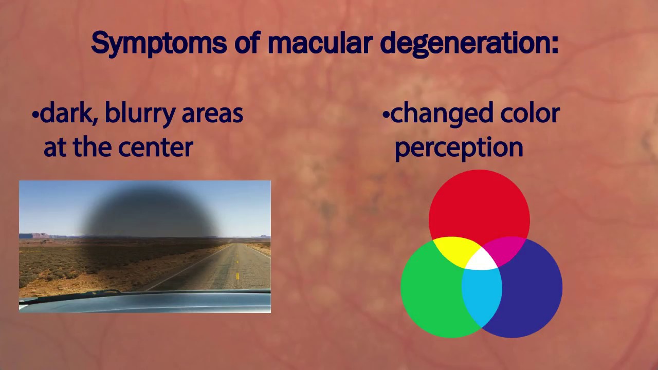 How to prevent or improve agerelated macular degeneration (AMD)? YouTube