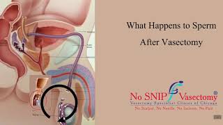What happens to the sperm after a vasectomy