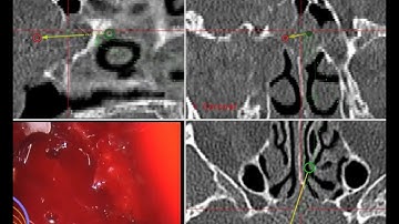 Scopis Augmented Reality: Path guidance to craniopharyngioma