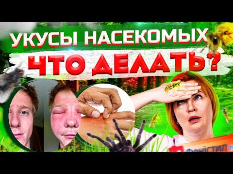 Укусы насекомых  что делать? Доктор Кобец