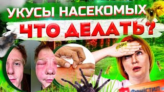 Укусы насекомых  что делать? Доктор Кобец