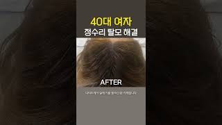 정수리 탈모로 고민이던 40대 여성