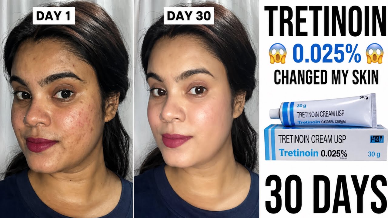 Tretinoin 0.025% Ka Result 😱 | 30 Days Skin Transformation | Real ...