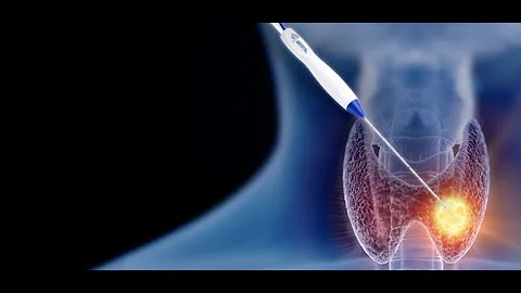 Thyroid Radiofrequency RFA vs Laser LA vs microwave ablation MWA.Pros and cons.