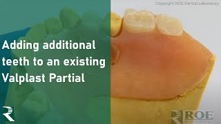 Valplast  Adding Additional Teeth to an Existing Valplast Partial