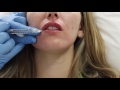 Juvederm lip filler injection by Dr. Shaun Patel in Miami, Florida.